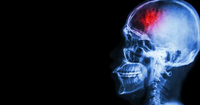 Head Injury